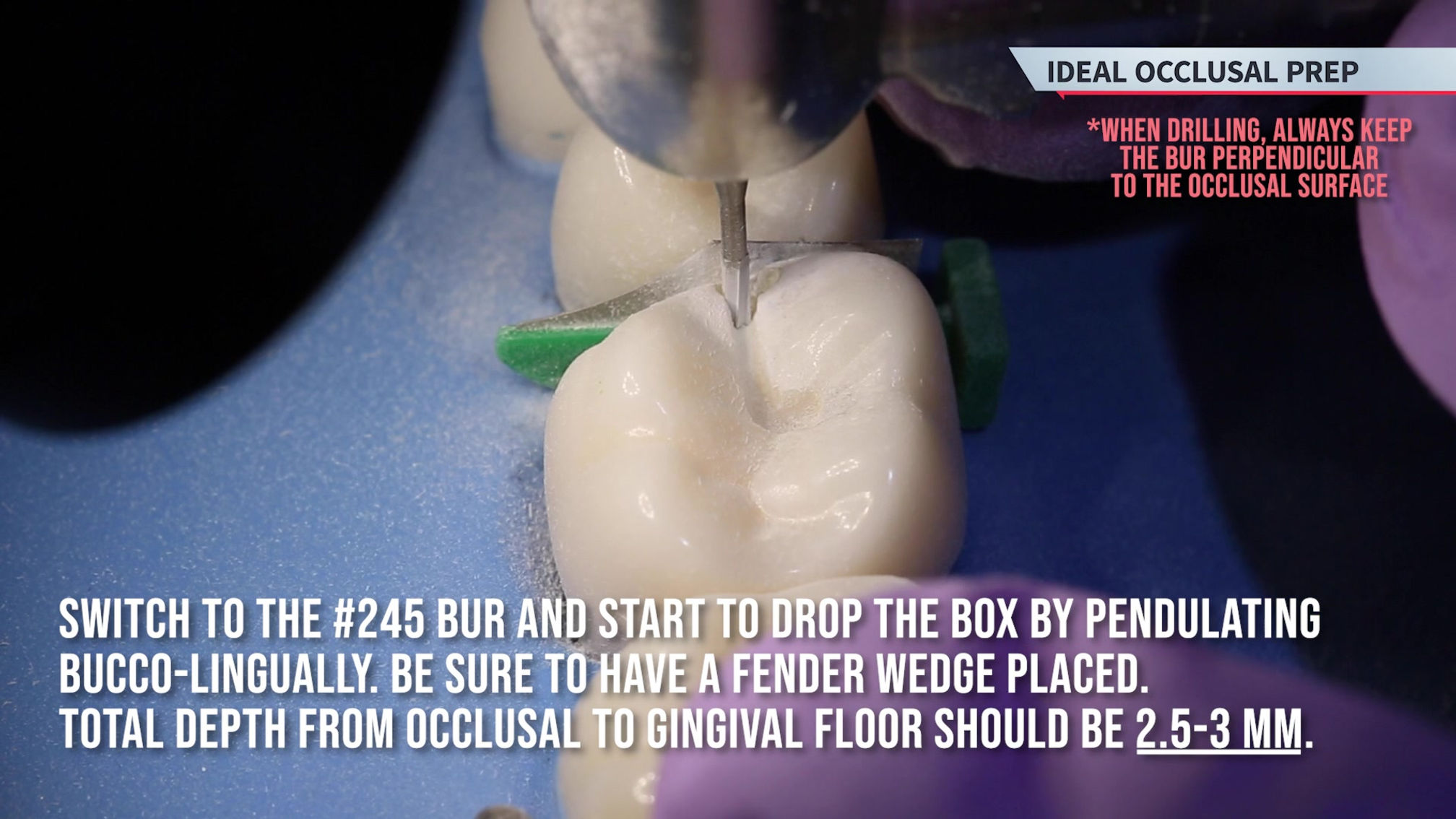 Class II Preparation